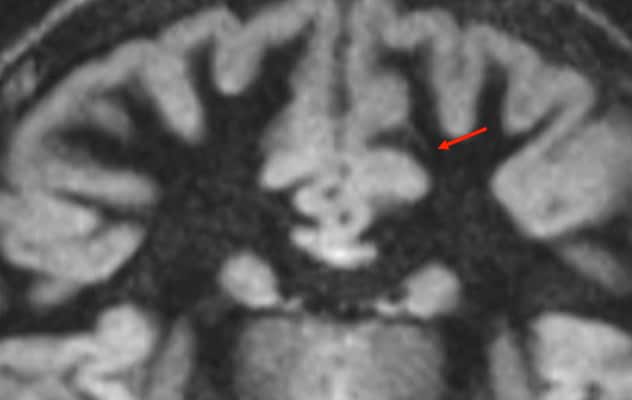 3-tesla MRI of epileptogenic lesion