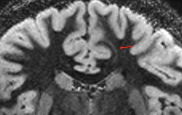 7-tesla MRI of epileptogenic lesion
