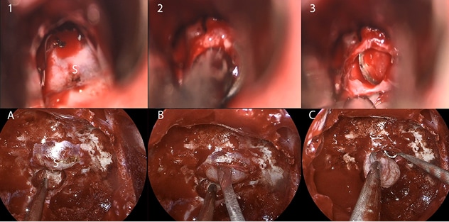 Comparación entre la cirugía pituitaria microscópica y endoscópica