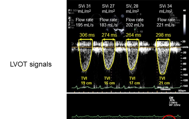Doppler signals during echocardiogram