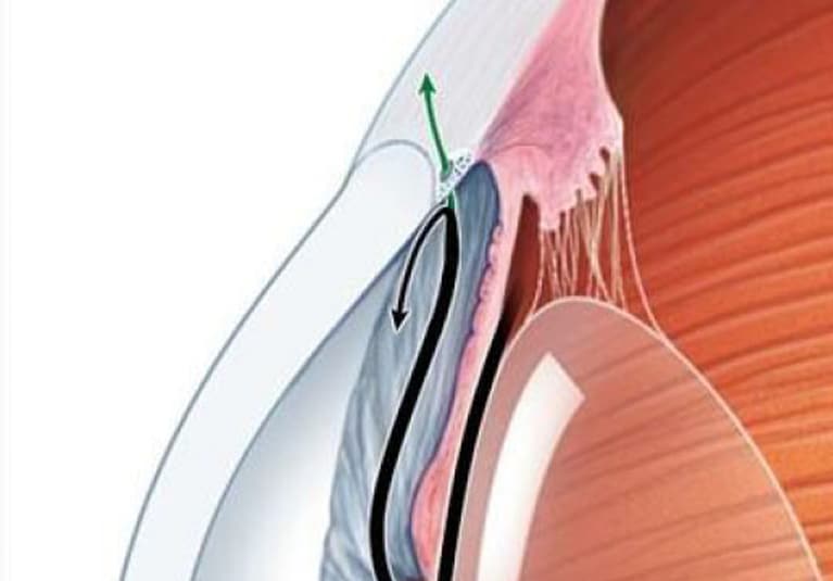 Netarsudil significantly reduces intraocular pressure in patients