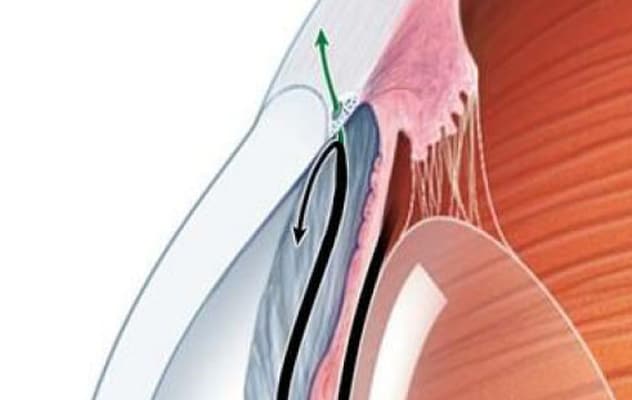 Presión intraocular en glaucoma de ángulo abierto primario