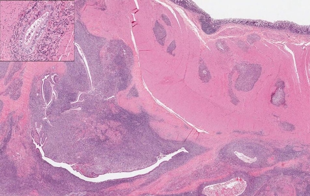 Endometriosis