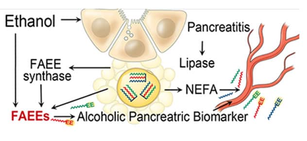 Alcoholic pancreatic biomarker