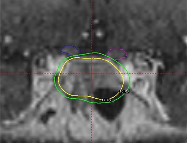 Highly challenging tumors