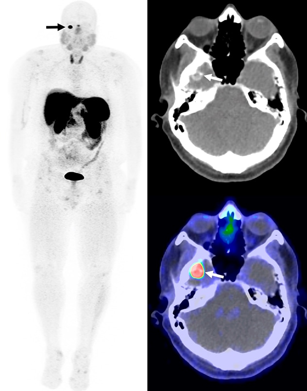 Calcified mass in the right middle cranial fossa