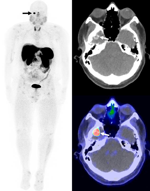 Tumor calcificado en la fosa craneal media derecha