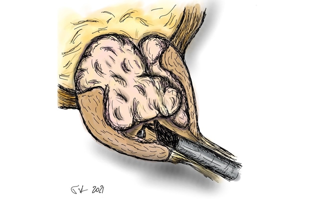 Transurethral enucleation