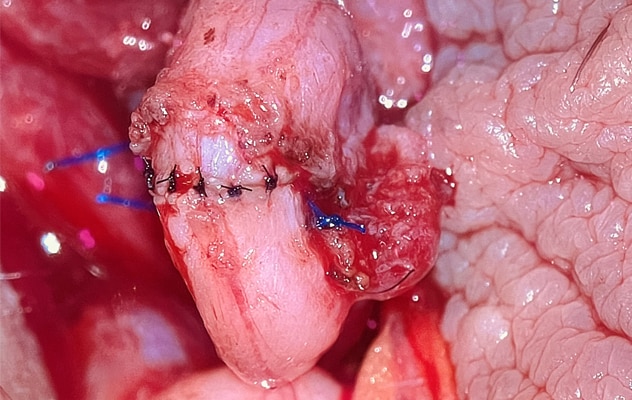Anastomosis en una vasovasostomía