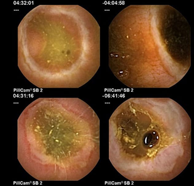 Changes consistent with NSAID enteropathy