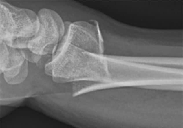 Displaced fracture of distal radius