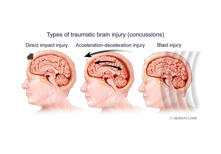 The Role of Bubbles in Brain Injury