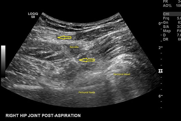 髋关节抽吸的超声波图像