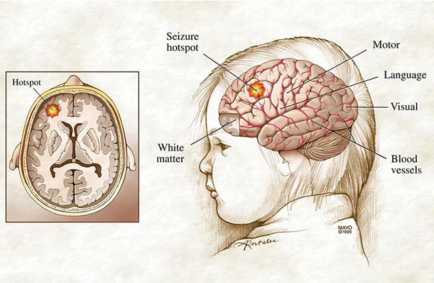 Pinpointing seizure origin sites