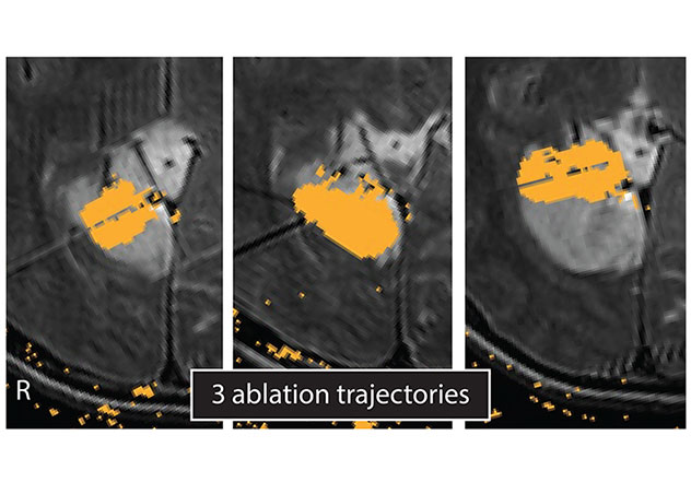 Laser ablation of an epileptogenic tumor