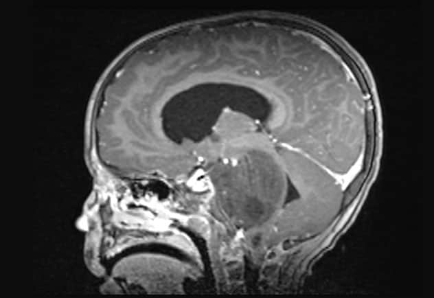 Sagittal T1-weighted MRI scan with contrast