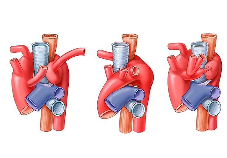 Get Vascular Rings Treatment | Cleveland Clinic Children's