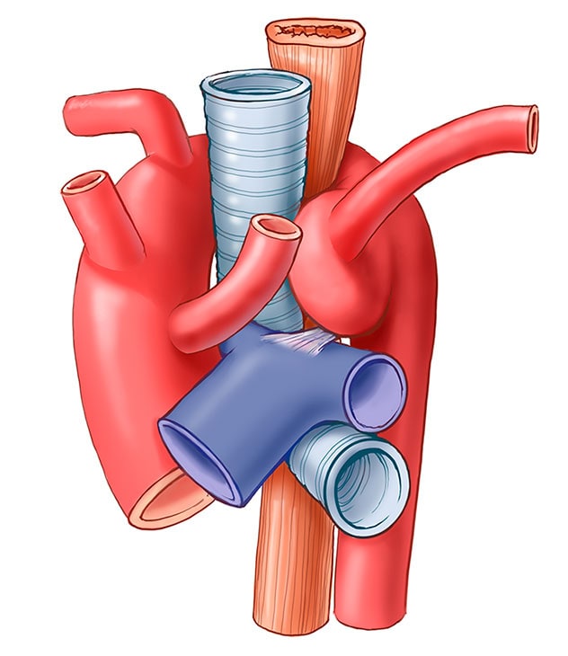 Newborn Heart Surgery