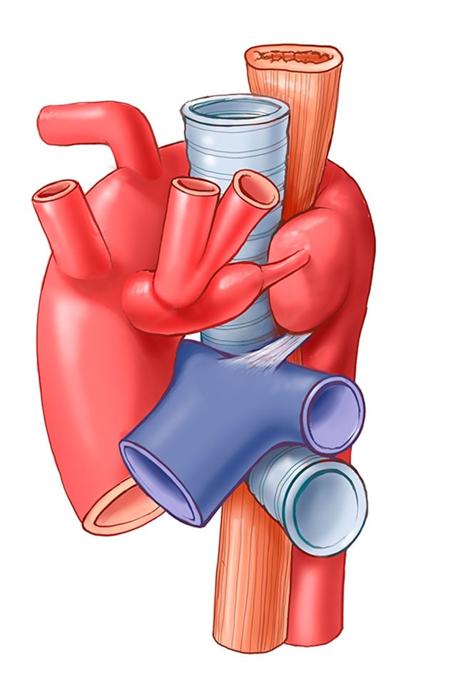 Double aortic arch