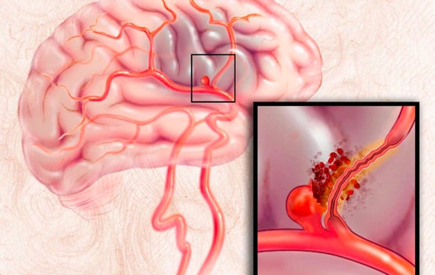 Dangers of rupture