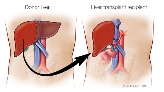 Deceased donor liver transplant