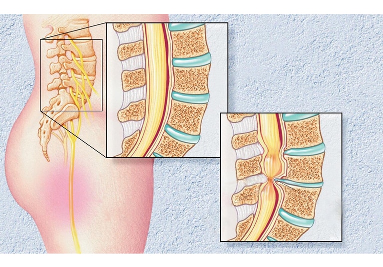 Spinal Stenosis - A Short Blog Post From Emed