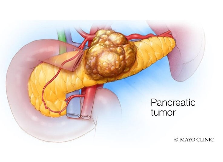 Se puede comer marisco con pancreatitis