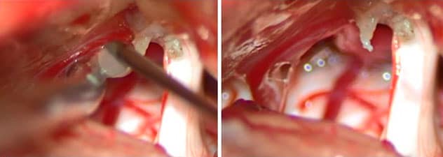 Microvascular decompression using fibrin