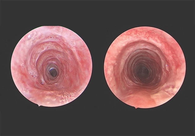 Tracheal wedge excision