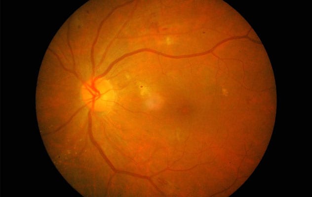 Retinopathy in right eye