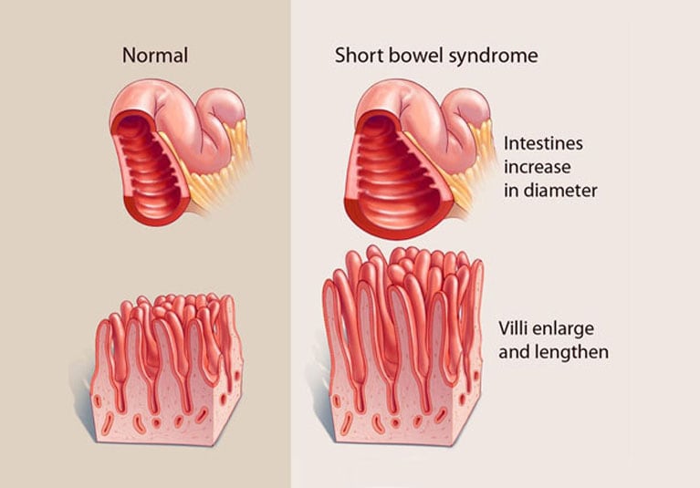 short bowel syndrome surgery
