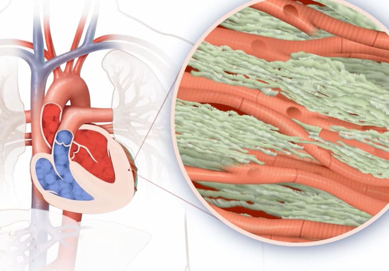 Amyloidosis, the heart transplant precursor to keep on your diagnostic  radar - Mayo Clinic