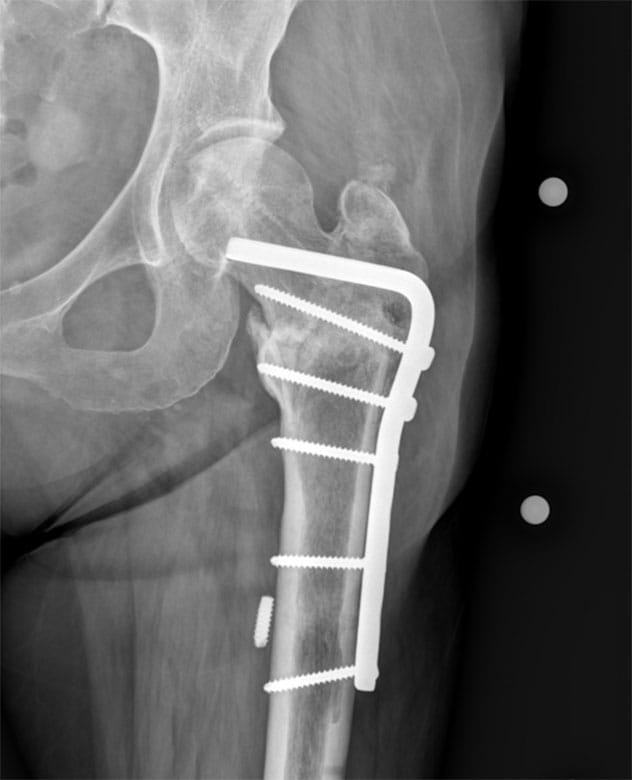 Nonunion repairs