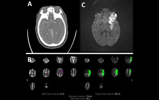Determining stroke etiology
