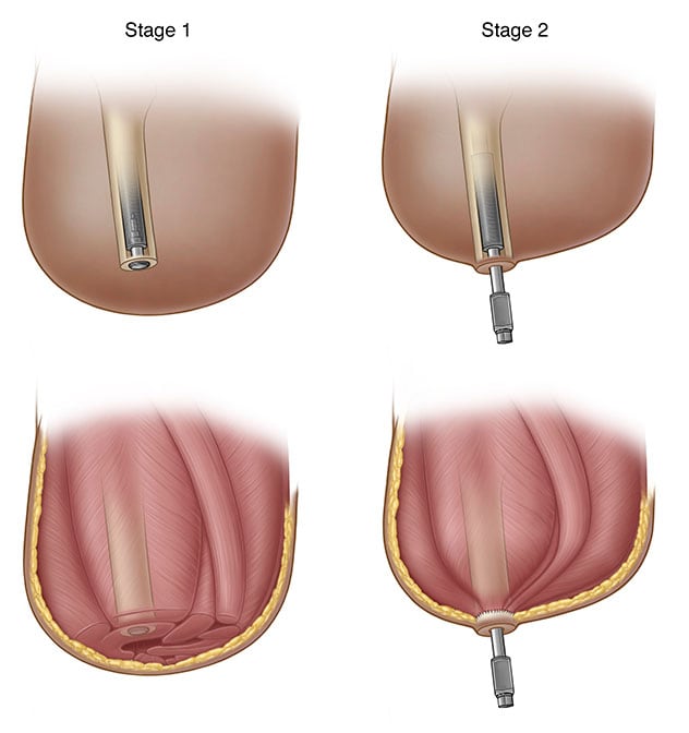 Etapas de osteointegración