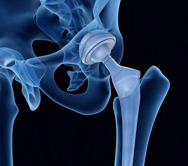 Total hip arthroplasty