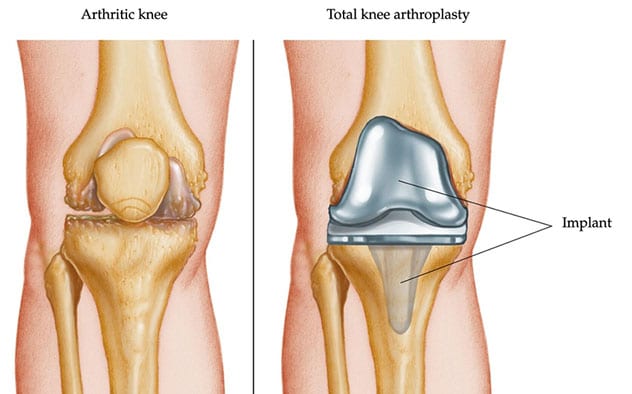 Knee implant