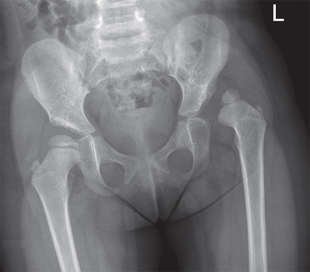 Left hip dislocation