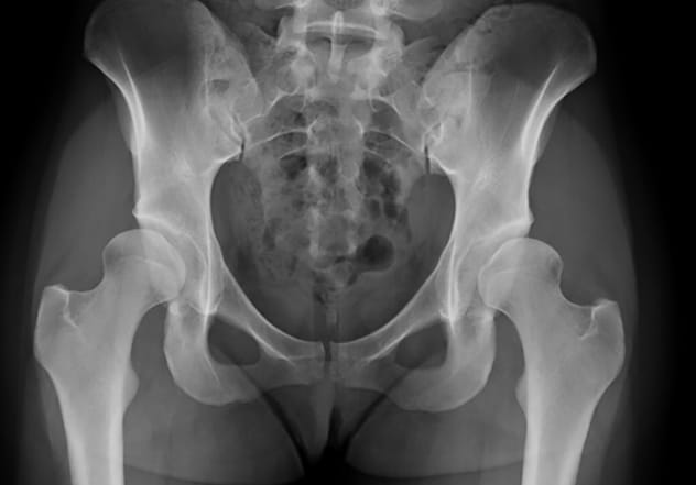 Hip dysplasia