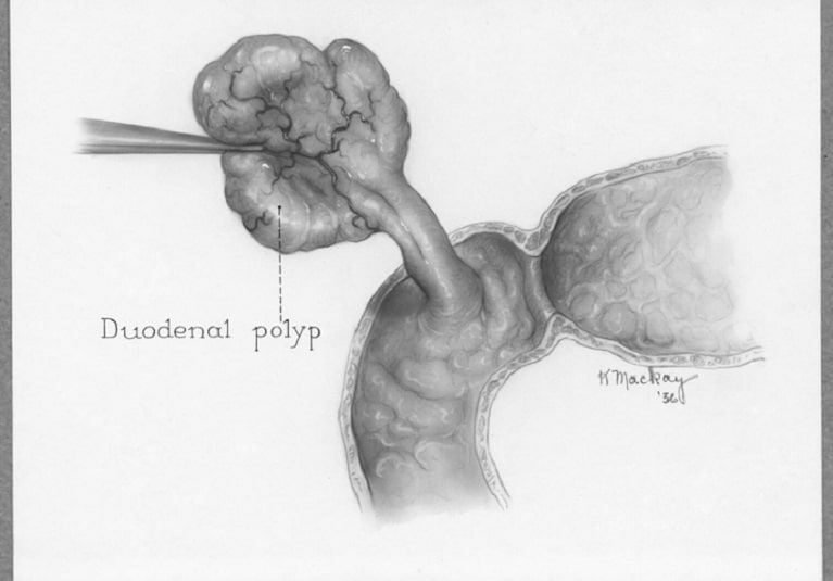 Weekly dose of erlotinib shows decreased duodenal polyp burden and side  effects for patients with FAP - Mayo Clinic