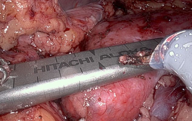 Renal mass