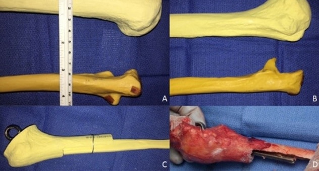 Bone loss