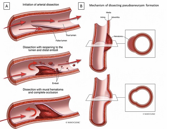 Artery dissections