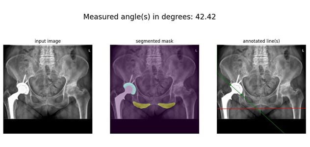 A deep learning pipeline for measuring acetabular inclination angle(s)