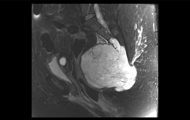 A large chordoma, a primary malignant sacral tumor