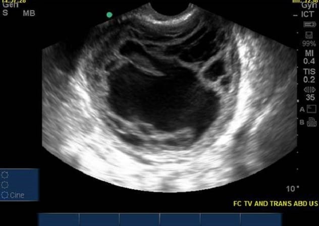 Pelvic ultrasound