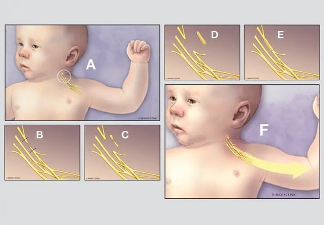 Neonatal brachial plexus injury surgery