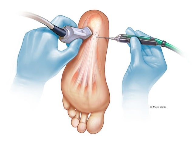 Percutaneous ultrasonic tenotomy/fasciotomy