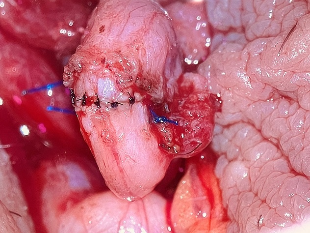 Procedimiento de reversión de la vasectomía