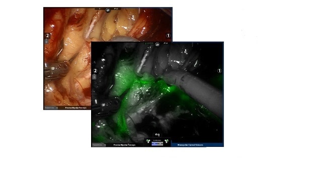 Sentinel lymph nodes at Mayo Clinic